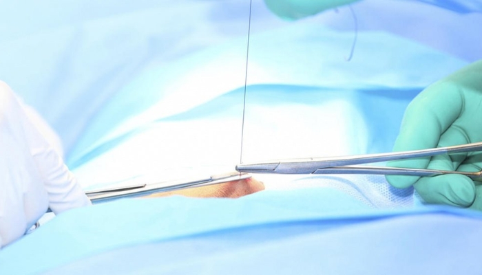 Quy trình cắt chỉ khâu vòng cổ tử cung chi tiết nhất